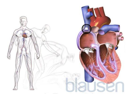 Bradyardi - bevsimelse