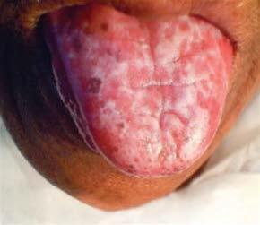 Oral lichen planus, retikulær type