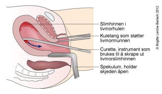 Utskraping av livmoren