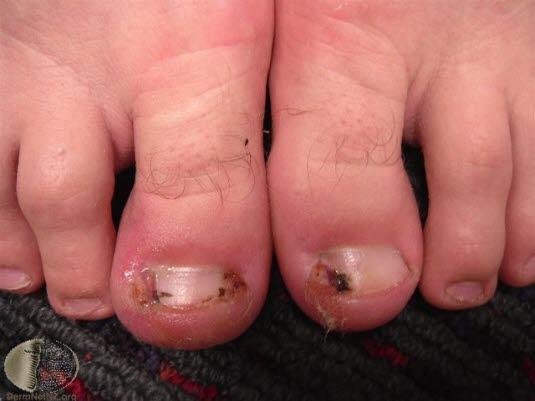 Inngrodd tånegl (betent) 1