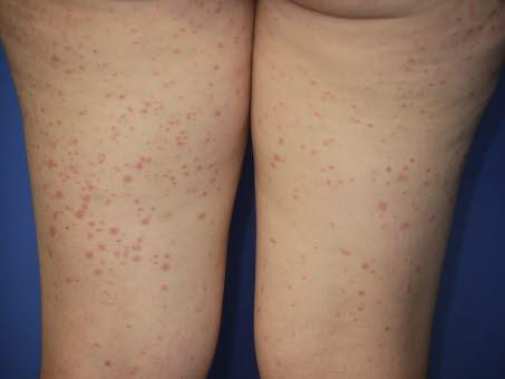 Henoch-Schönleins purpura, lår