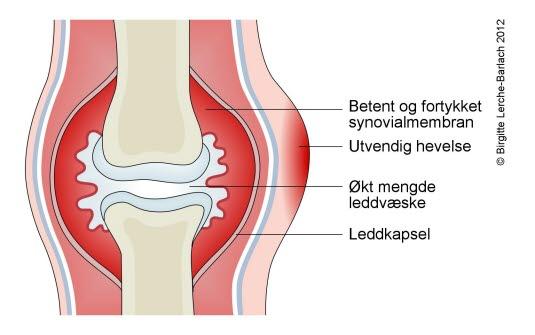 Akutt leddbetennelse (artritt)
