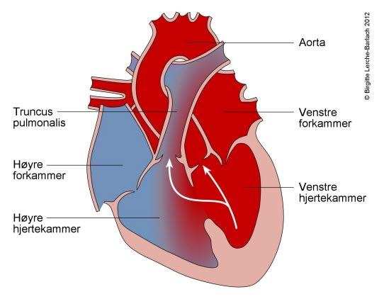 Ventrikkel septumdefekt