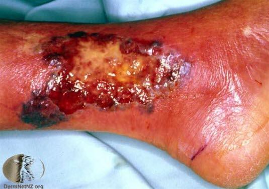 Pyoderma gangrenosum