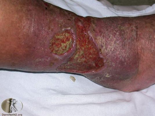 Leggsår, kronisk venøst