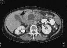 CT-bilde av bukspyttkjertel med svulst