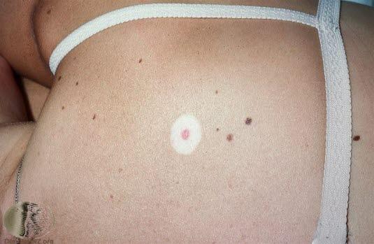 Nevus, halonevus