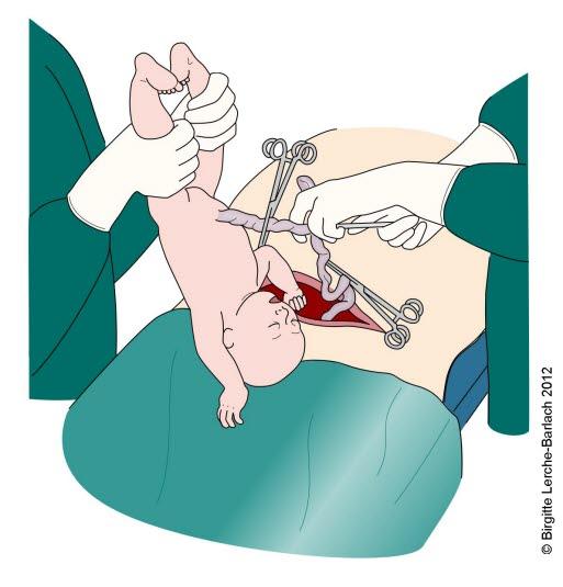 Barn som fødes ved keisersnitt.