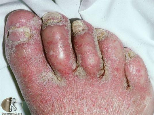 Kronisk dermatitt, uttalt