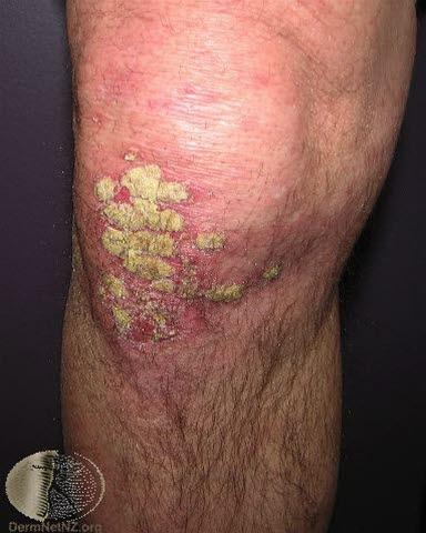 Psoriasis, kne