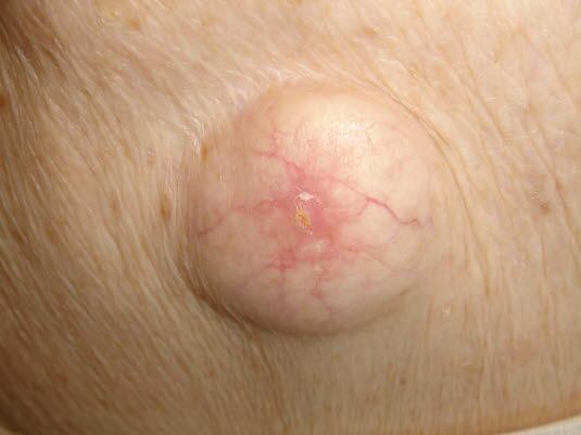 Lukket epidermoid cyste 