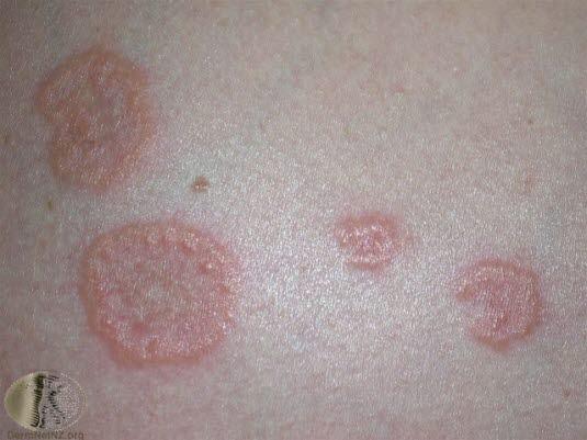 Svangerskaps-pemfigoid 2