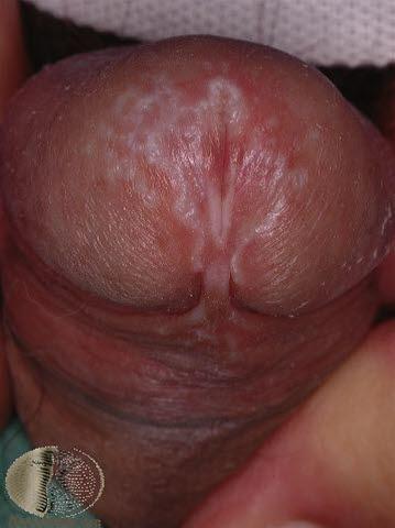 Lichen sclerosis, mann