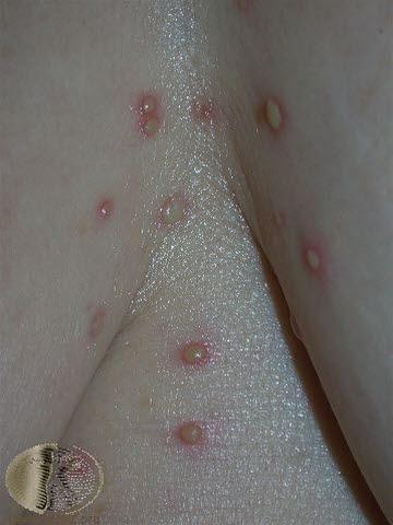 Blemme i huden, pustel