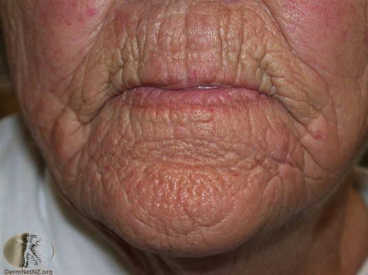 Rynker (uttalt elastose)