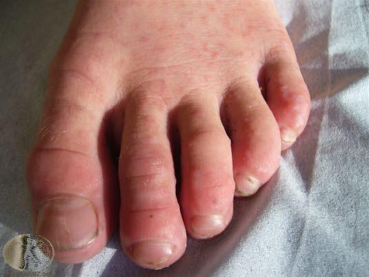 Hånd-, fot- og munnsykdom 2