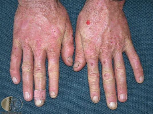 Porfyria cutanea tarda