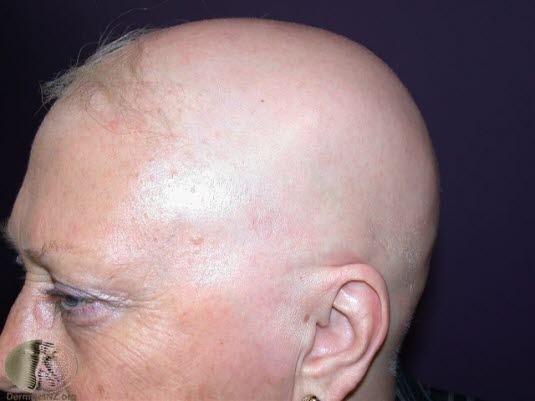 Alopesia, totalis