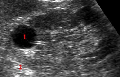 Nyrecyste - ultralydbilde