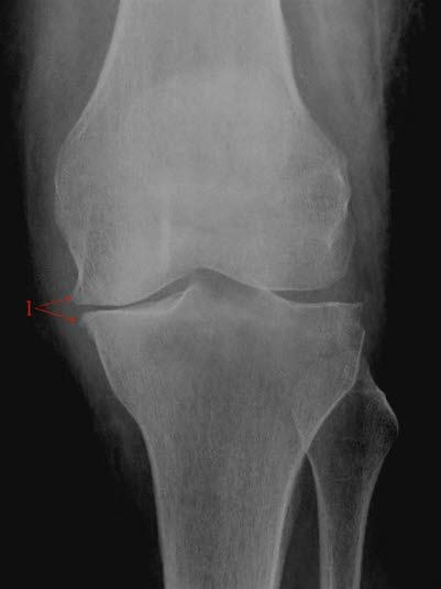 Moderate slitasjeforandringer.