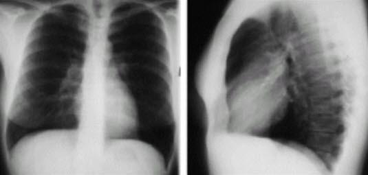 Røntgenbilde av lunger med blodpropp