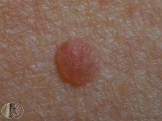 Nevus, dermal (hos eldre)