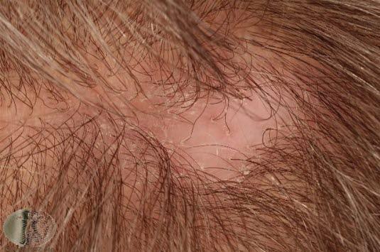 Lokalisert alopeci