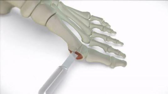 Copyright beskyttet bilde. Kun brukt til å vise til hallux valgus operasjon på YouTube.