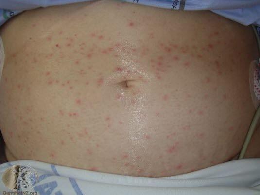 Vannkopper, tidlig fase