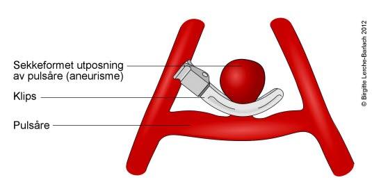 Aneurisme som behandles med klips