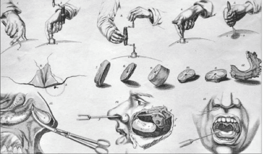 Kirurgisk operasjonsteknikk måtte læres i studiet på 1800-tallet. Her vises operasjon for nesepolypper.