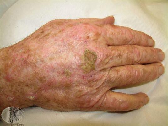 Aktinisk keratose, horn 