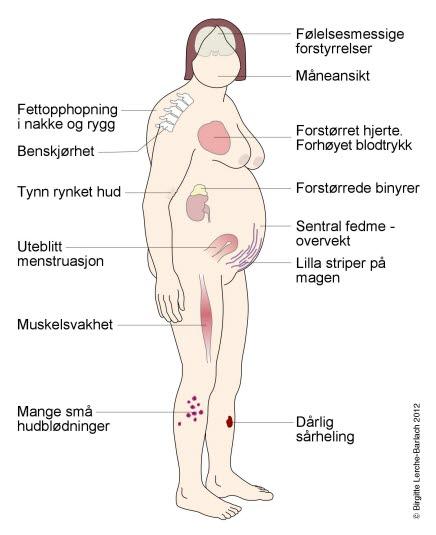Symptomer ved Cushing syndrom