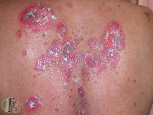 Pemfigus vulgaris 1