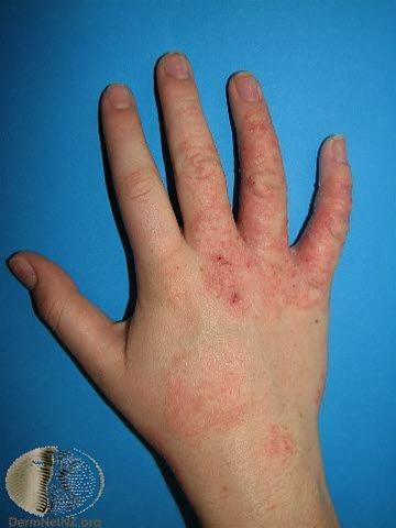 Atopisk eksem, barn hånd