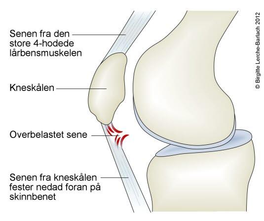 Betennelse i senefestet på kneskålens nedre kant