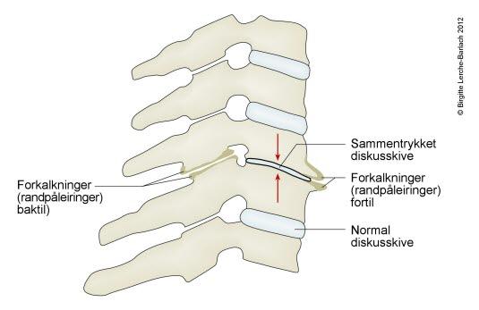 Slitasjeforandringer i nakkesøylen