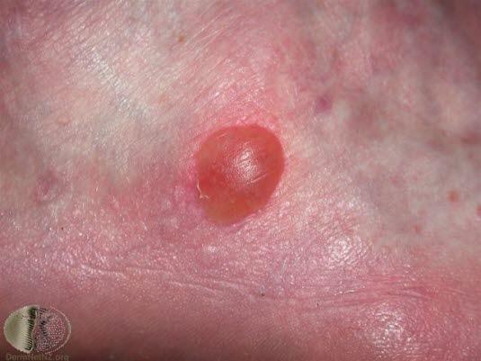 Blemme, friksjon (gnagsår).jpg