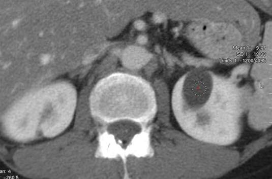 CT-bilde av nyrecyste