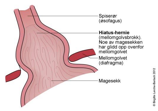 Mellomgulvsbrokk (hiatus hernie)