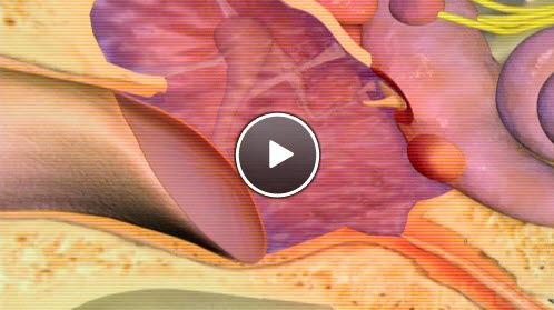 Mellomørebetennelse