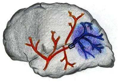 Illustrasjon: Hjernen med blodpropp