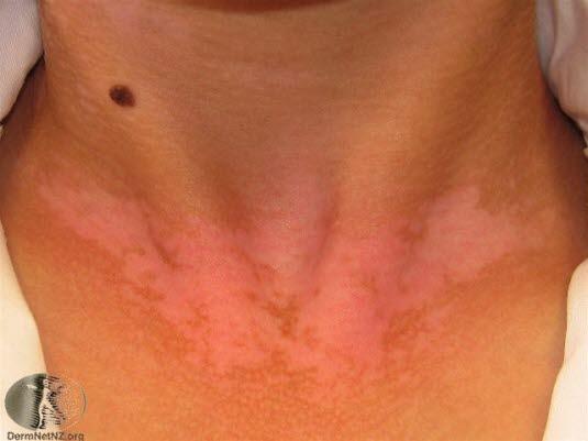 Vitiligo 1