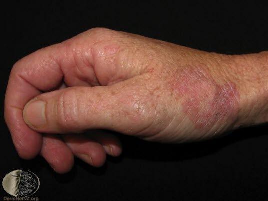 Mb Bowen er en in situ-variant som over tid utvikler seg til infiltrerende spinocellulært carcinom