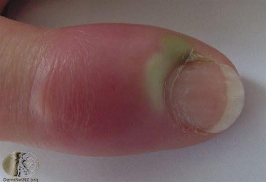 Paronykia, akutt reaksjon