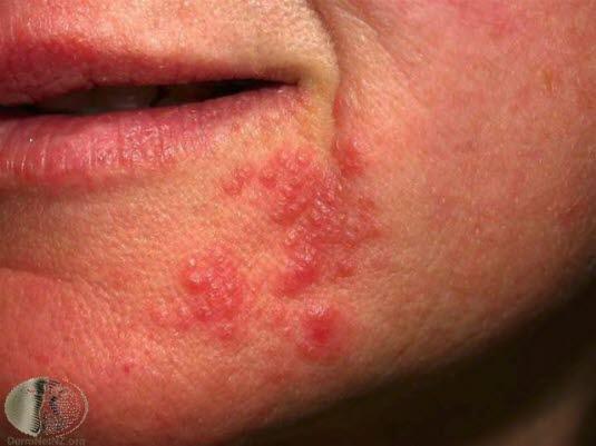 Perioral dermatitt