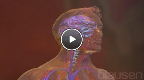 hjernehinnebetennelse