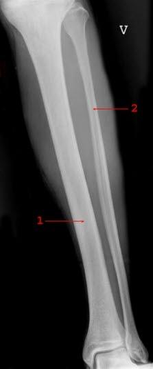 Normalt røntgenbilde av legg