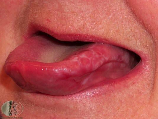 Oral lichen planus 1