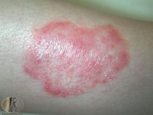 Tinea corporis 2